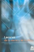 Lesiones de la mano y la mueca
